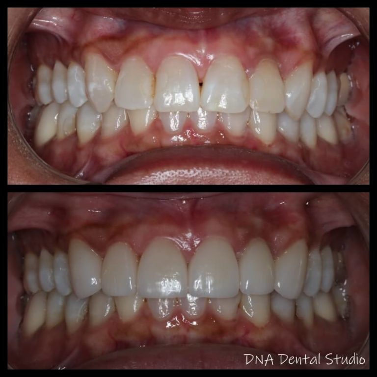 Teeth Whitening in Burbank CA - DNA Dental Studio