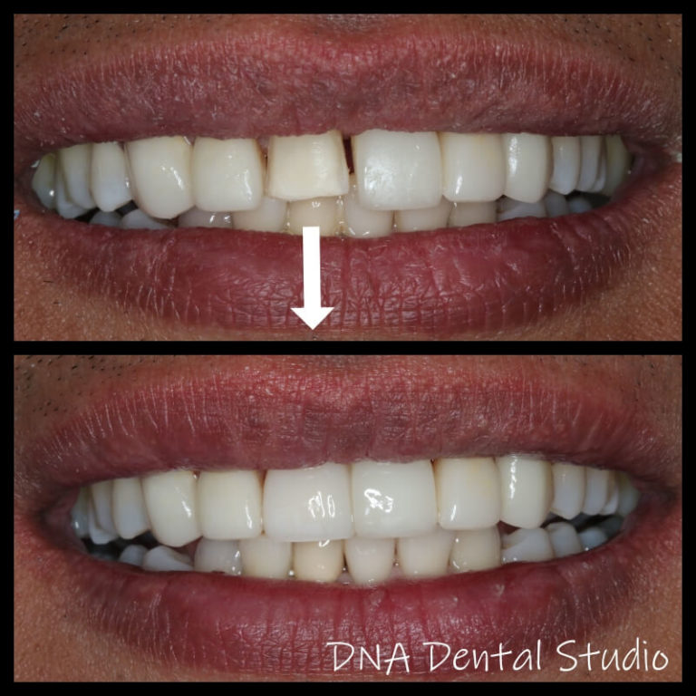 Teeth Whitening in Burbank CA - DNA Dental Studio