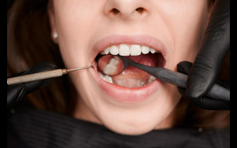 How Fillings Restoration Can Save Your Teeth?