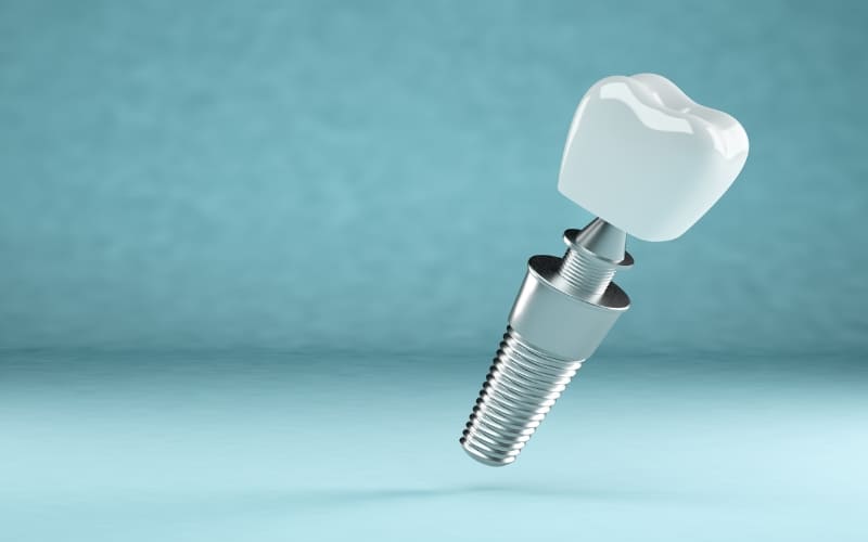 Dental Implants in Burbank