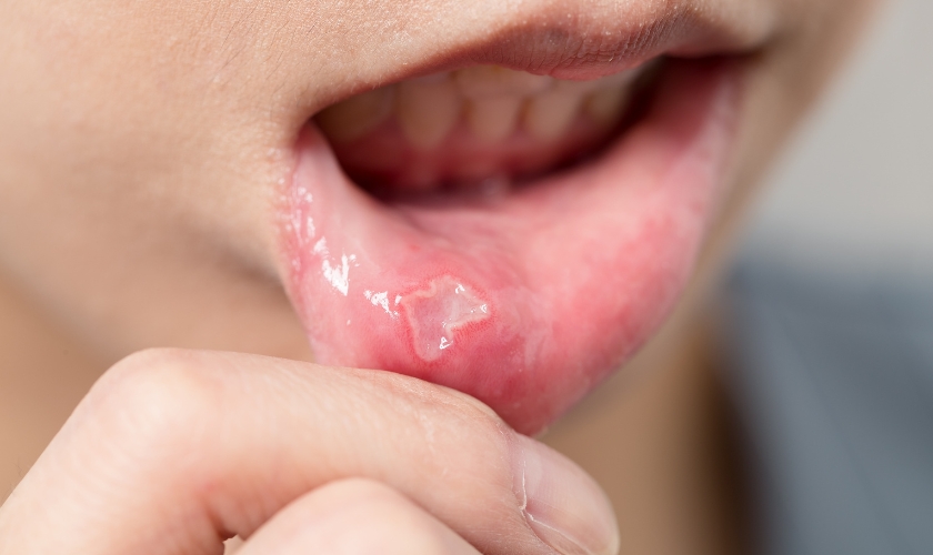 most common cause of a mouth ulcer