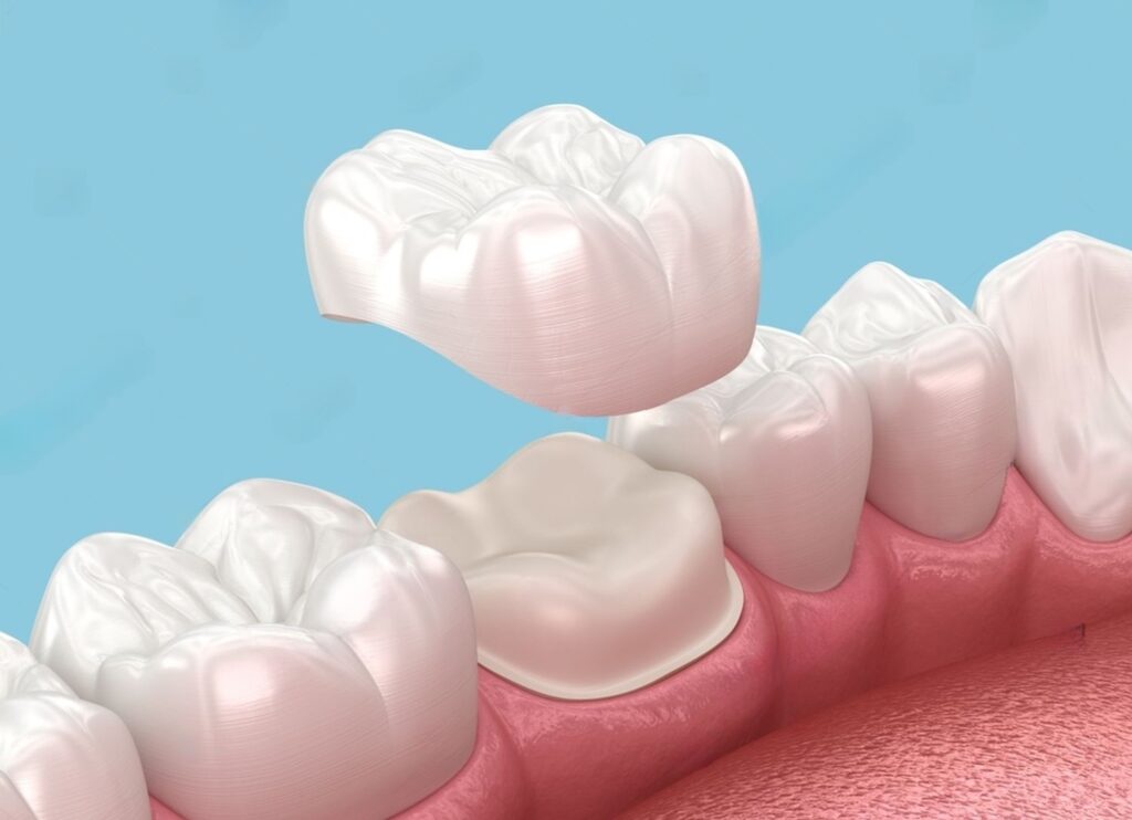 Health Benefits Of Dental Crowns