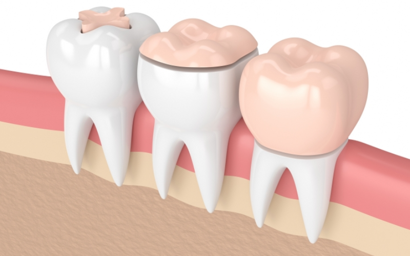 Inlays and Onlays To Restore Your Smile