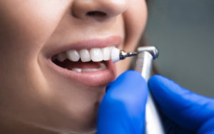 Benefits Of Prophylaxis Teeth Cleaning